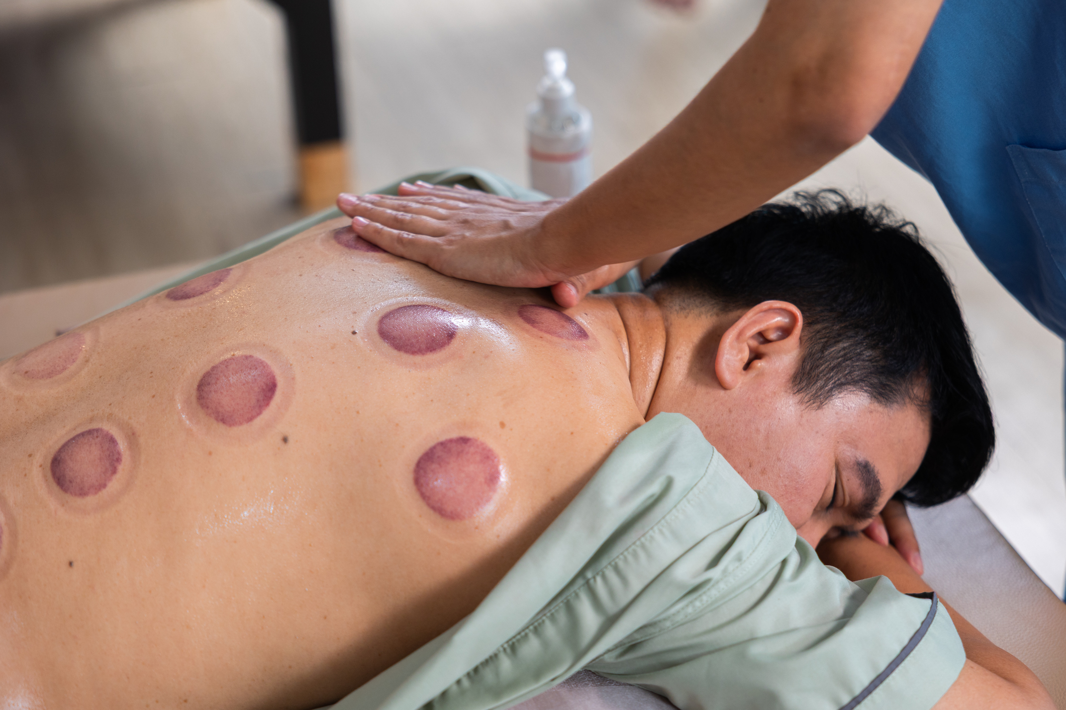 ‘Wet cupping’ mag niet zomaar zonder arts gebeuren, maar bijna alle aanbieders doen dat toch, ziet inspectie