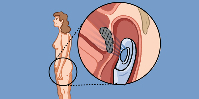 A new ultrasound technique promises to spare patients from surgery for digestive endometriosis